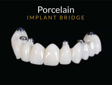 porcelain implant bridge