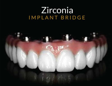 zirconia implant bridge