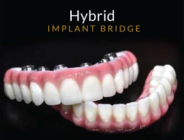 hybird implant bridge