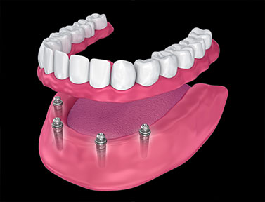 4-implant-overdenture